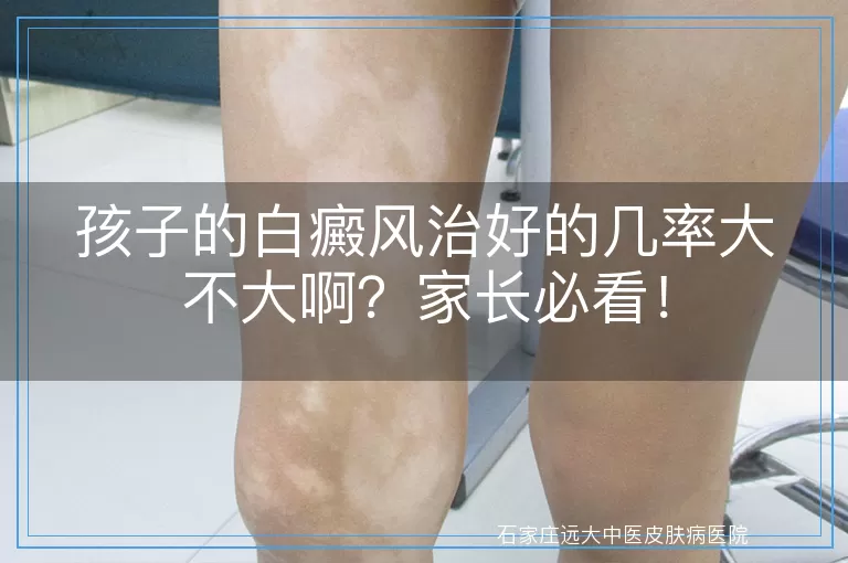 孩子的白癜风治好的几率大不大啊？家长必看！