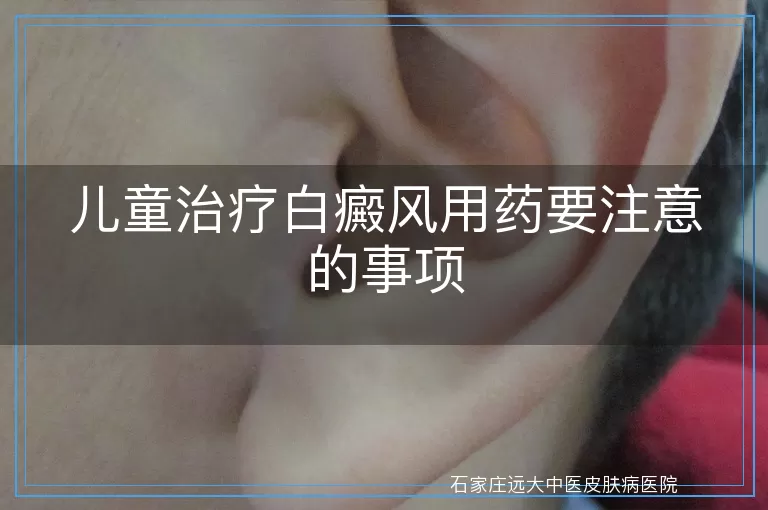 儿童治疗白癜风用药要注意的事项