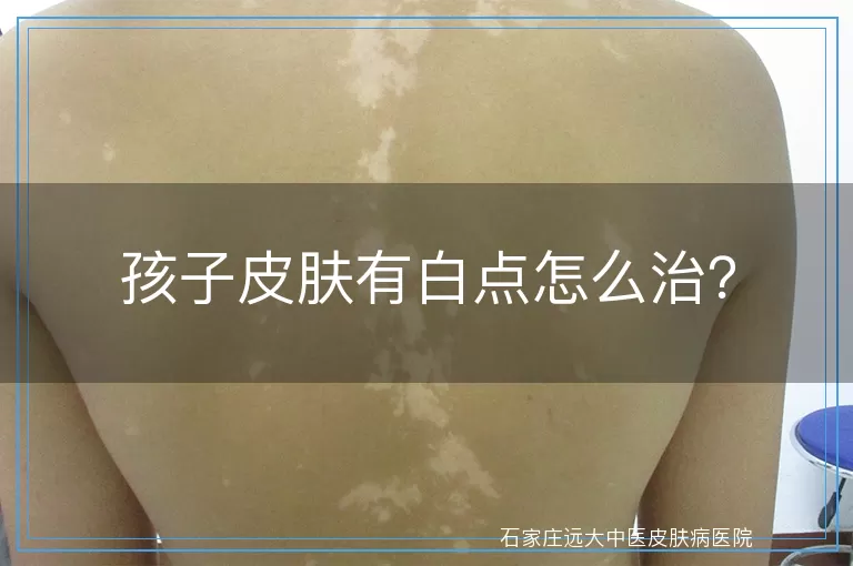 孩子皮肤有白点怎么治？