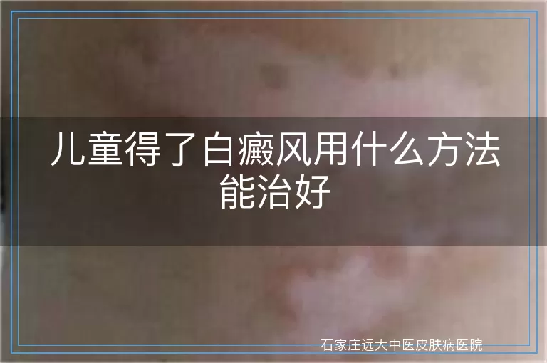 儿童得了白癜风用什么方法能治好