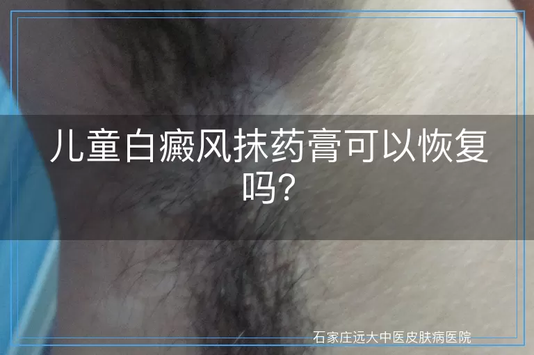 儿童白癜风抹药膏可以恢复吗？