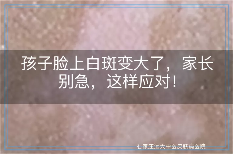孩子脸上白斑变大了，家长别急，这样应对！