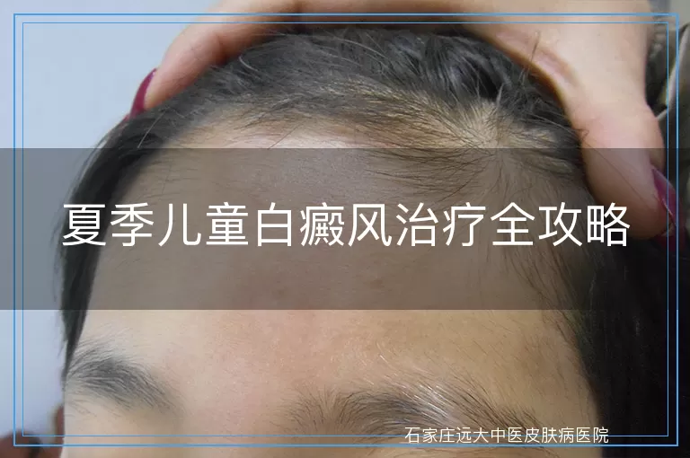 夏季儿童白癜风治疗全攻略