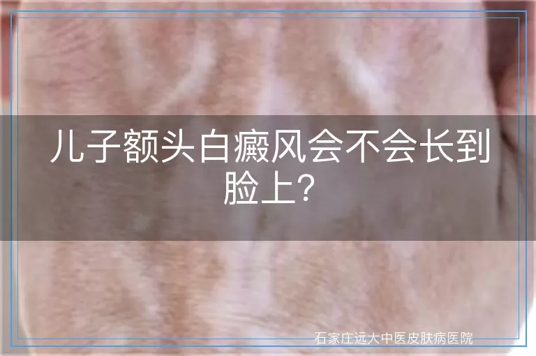 儿子额头白癜风会不会长到脸上？