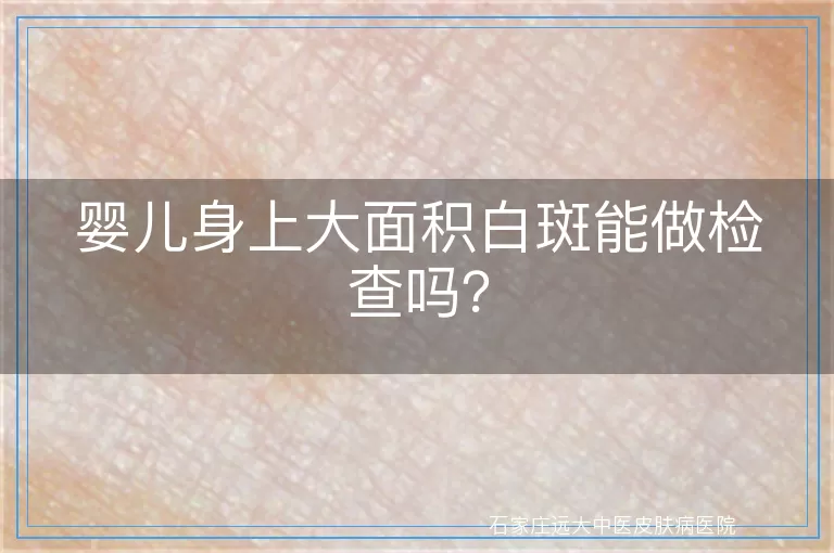 婴儿身上大面积白斑能做检查吗？