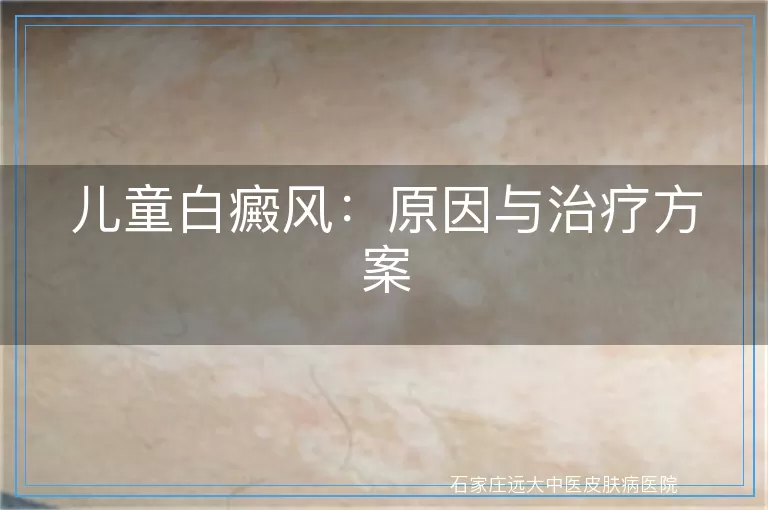 儿童白癜风：原因与治疗方案