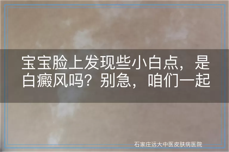 宝宝脸上发现些小白点，是白癜风吗？别急，咱们一起来看看！