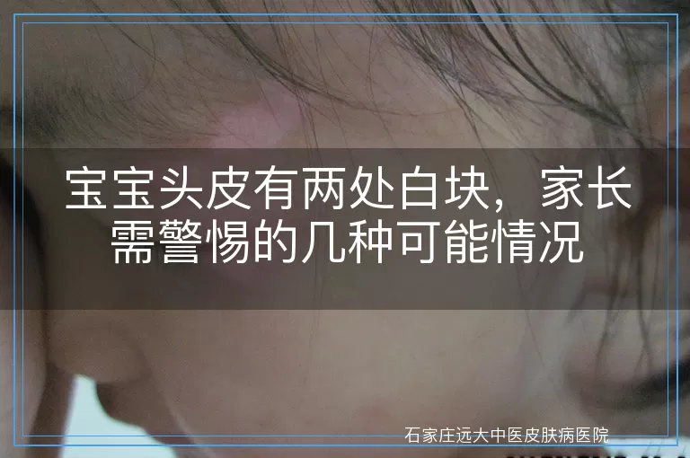 宝宝头皮有两处白块，家长需警惕的几种可能情况