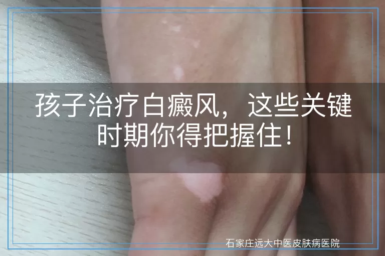 孩子治疗白癜风，这些关键时期你得把握住！