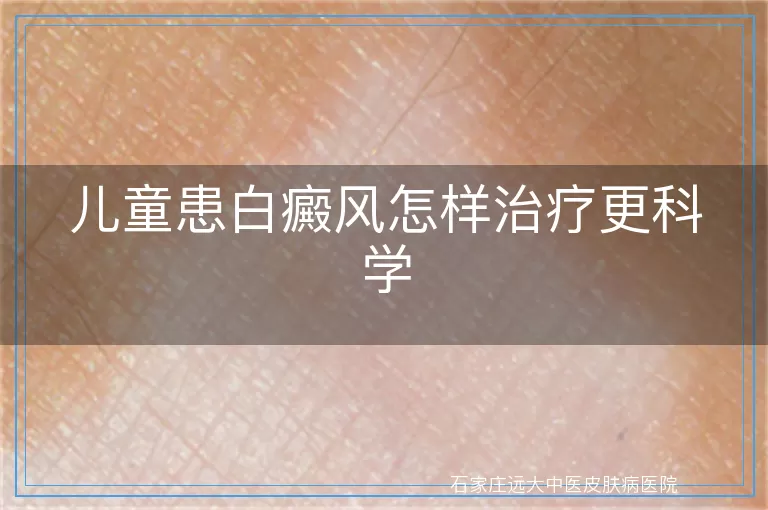 儿童患白癜风怎样治疗更科学