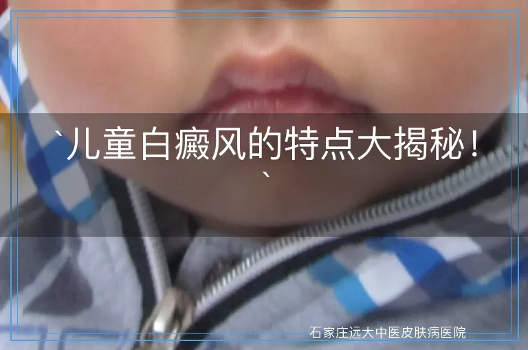 儿童白癜风的特点大揭秘！