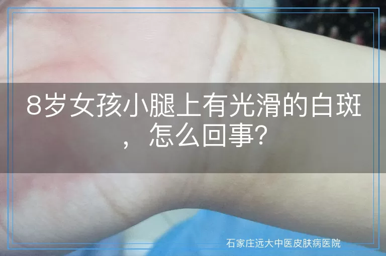 8岁女孩小腿上有光滑的白斑，怎么回事？