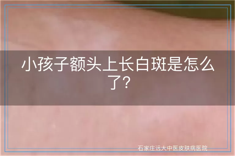 小孩子额头上长白斑是怎么了？