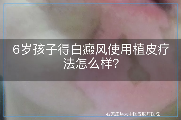 6岁孩子得白癜风使用植皮疗法怎么样？