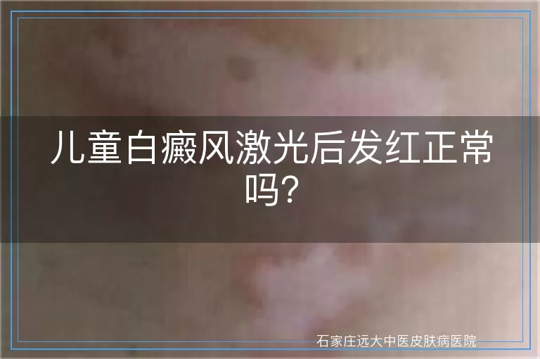 儿童白癜风激光后发红正常吗？