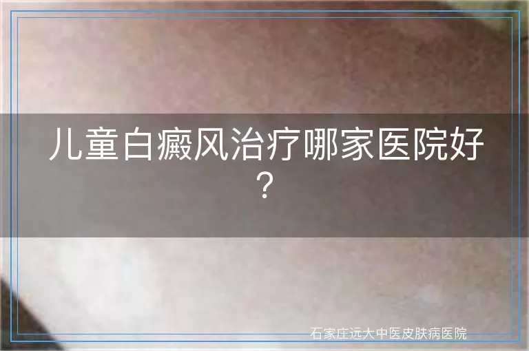 儿童白癜风治疗哪家医院好？