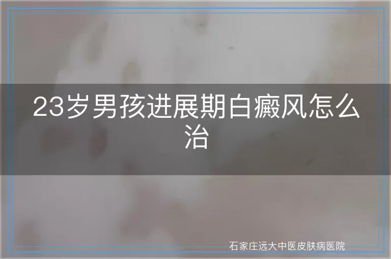 23岁男孩进展期白癜风怎么治