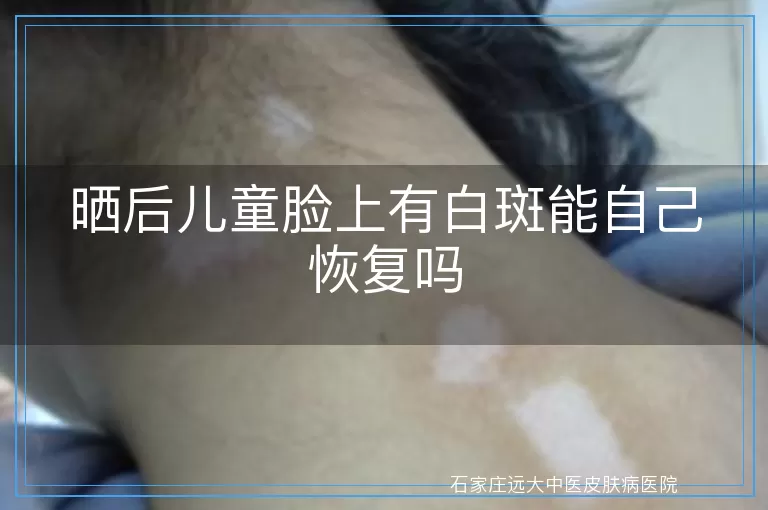 晒后儿童脸上有白斑能自己恢复吗