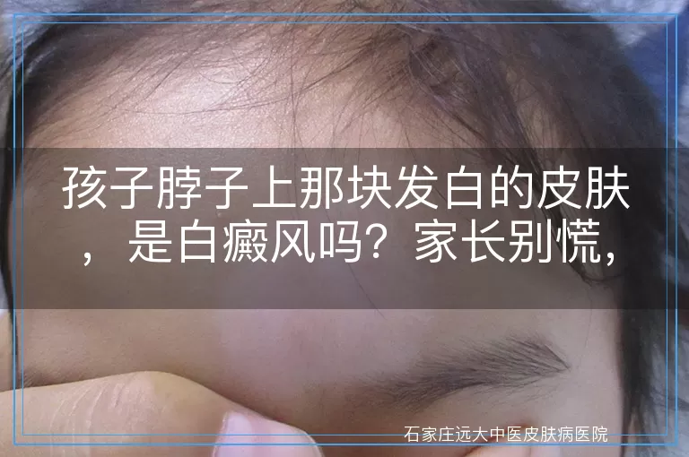 孩子脖子上那块发白的皮肤，是白癜风吗？家长别慌，先了解这些！