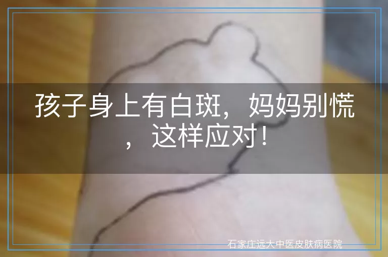 孩子身上有白斑，妈妈别慌，这样应对！