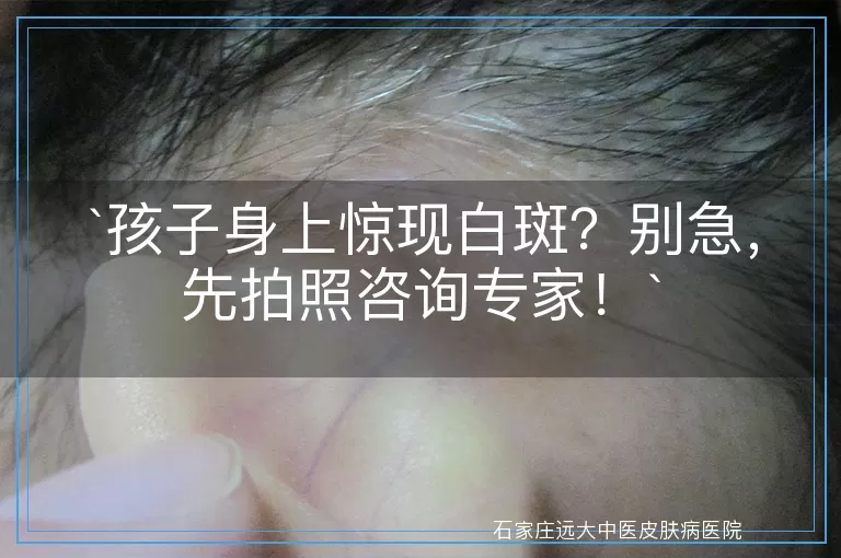 孩子身上惊现白斑？别急，先拍照咨询专家！