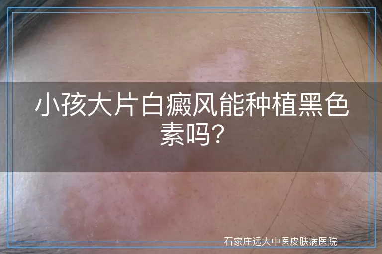 小孩大片白癜风能种植黑色素吗？