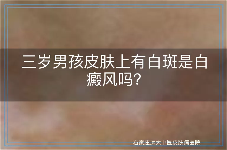 三岁男孩皮肤上有白斑是白癜风吗？