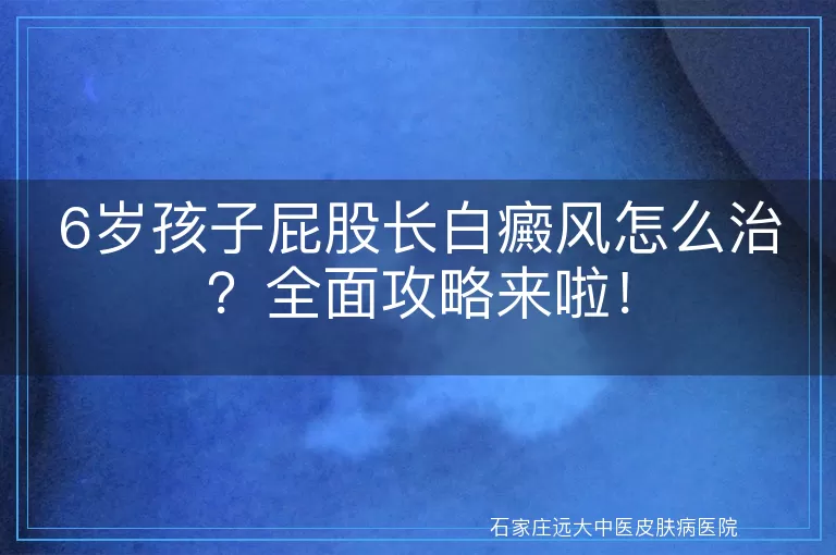 6岁孩子屁股长白癜风怎么治？全面攻略来啦！