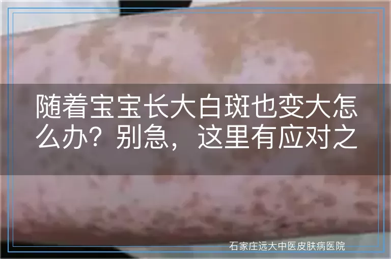 随着宝宝长大白斑也变大怎么办？别急，这里有应对之策！