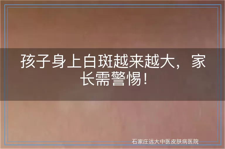 孩子身上白斑越来越大,家长需警惕!