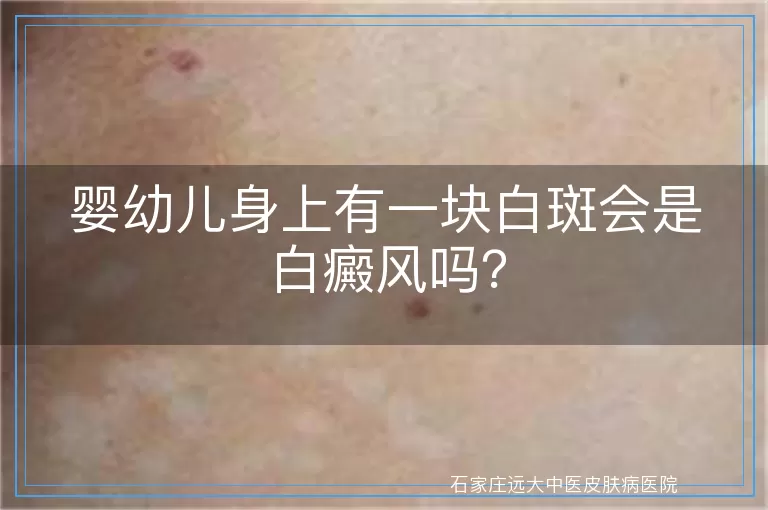 婴幼儿身上有一块白斑会是白癜风吗?
