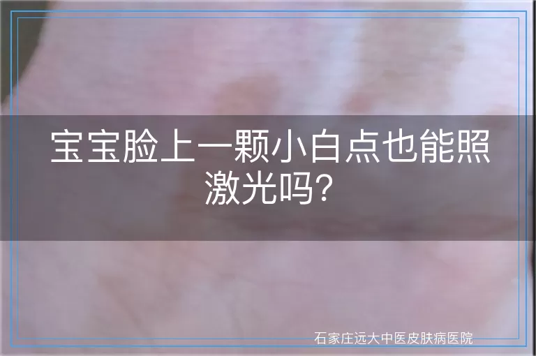 宝宝脸上一颗小白点也能照激光吗?