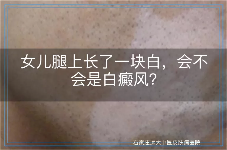 女儿腿上长了一块白,会不会是白癜风?
