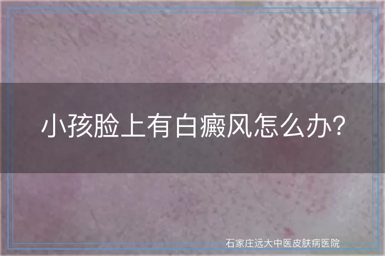 小孩脸上有白癜风怎么办?