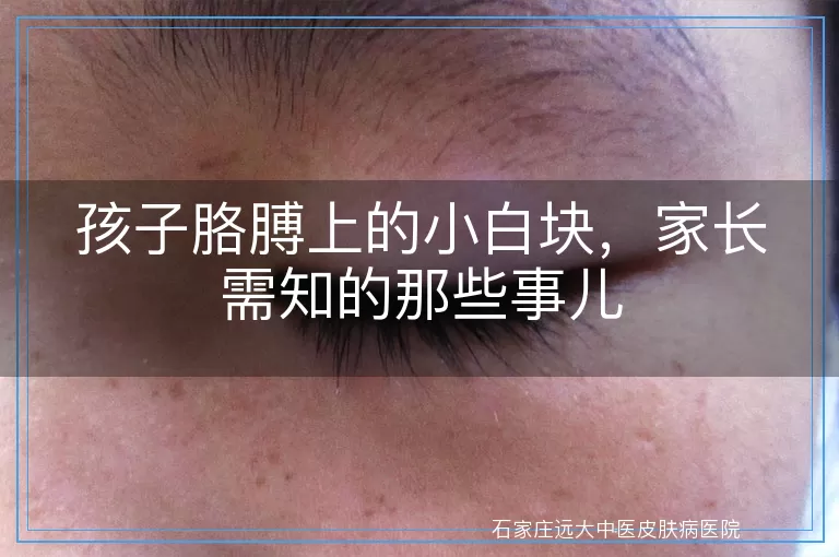 孩子胳膊上的小白块，家长需知的那些事儿