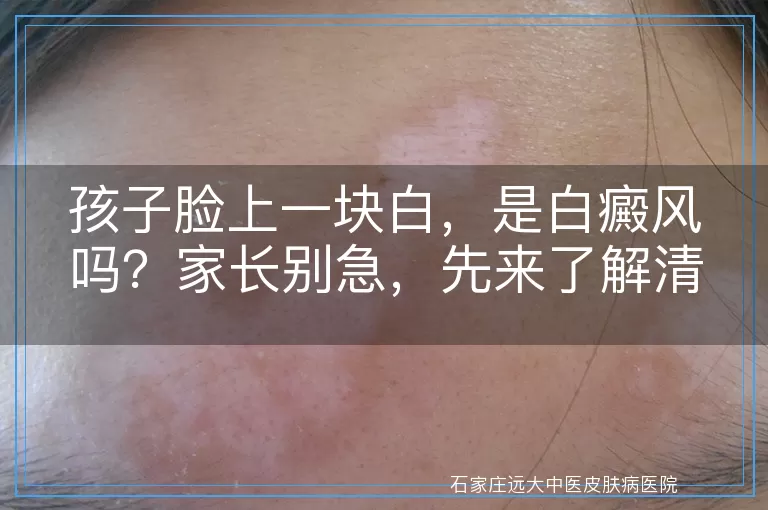 孩子脸上一块白，是白癜风吗？家长别急，先来了解清楚！