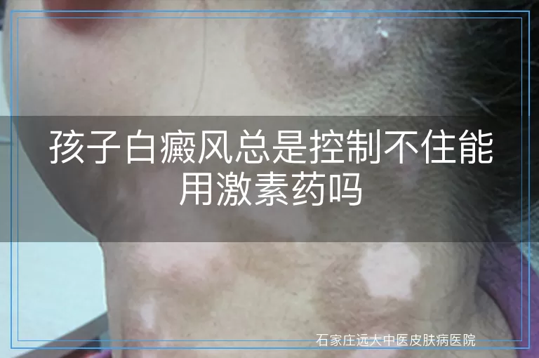 孩子白癜风总是控制不住能用激素药吗