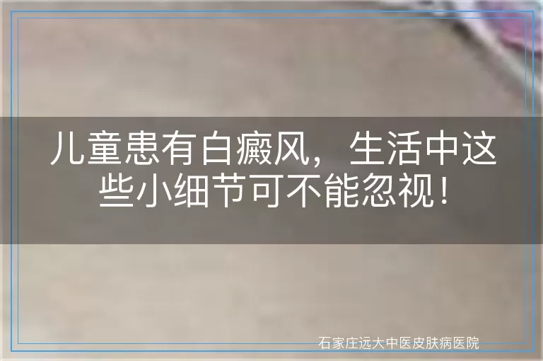 儿童患有白癜风，生活中这些小细节可不能忽视！