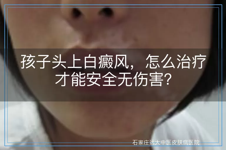 孩子头上白癜风，怎么治疗才能安全无伤害？