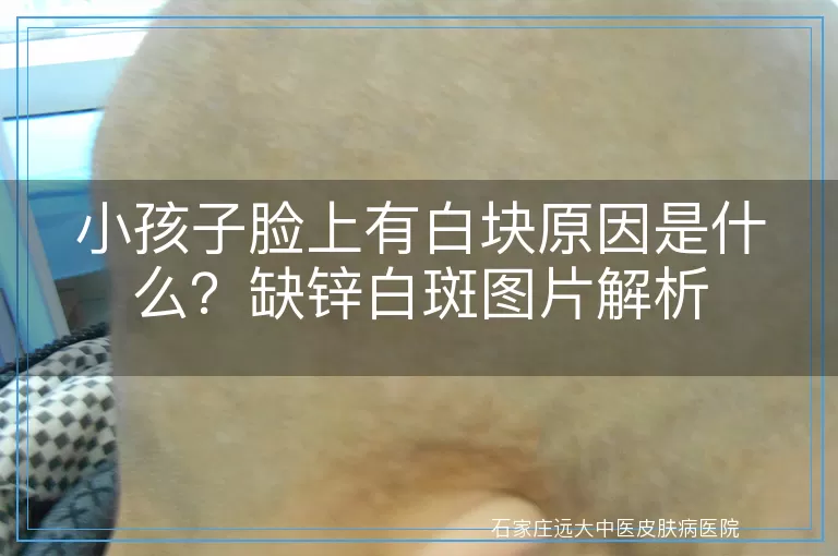 小孩子脸上有白块原因是什么？缺锌白斑图片解析