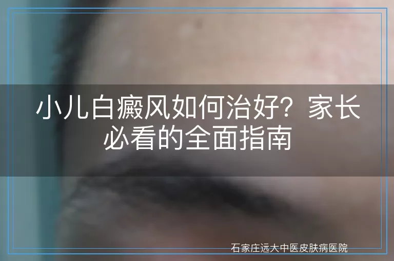 小儿白癜风如何治好？家长必看的全面指南