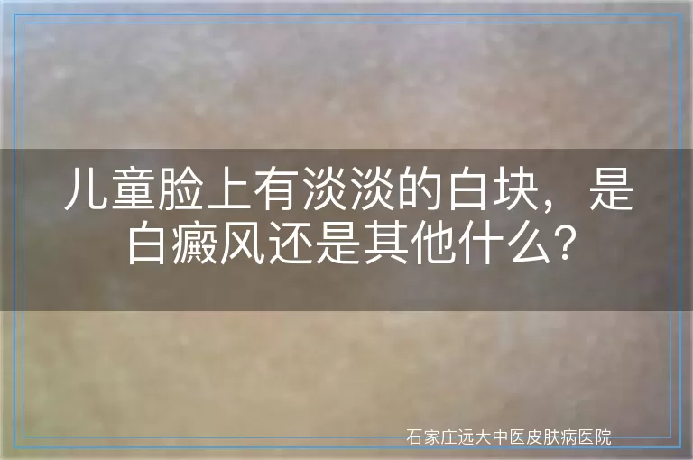 儿童脸上有淡淡的白块，是白癜风还是其他什么？