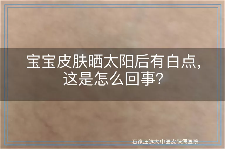 宝宝皮肤晒太阳后有白点，这是怎么回事？