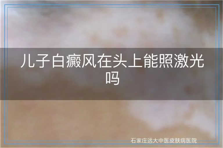 儿子白癜风在头上能照激光吗