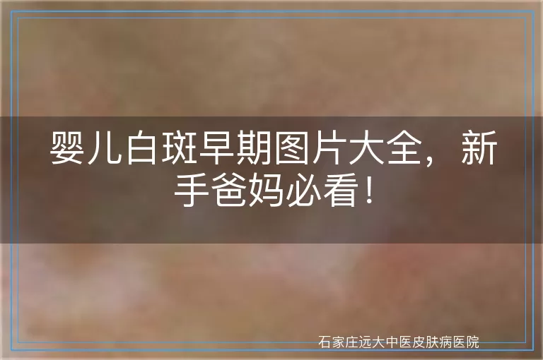 婴儿白斑早期图片大全，新手爸妈必看！