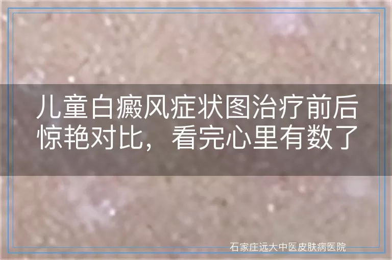 儿童白癜风症状图治疗前后惊艳对比，看完心里有数了！