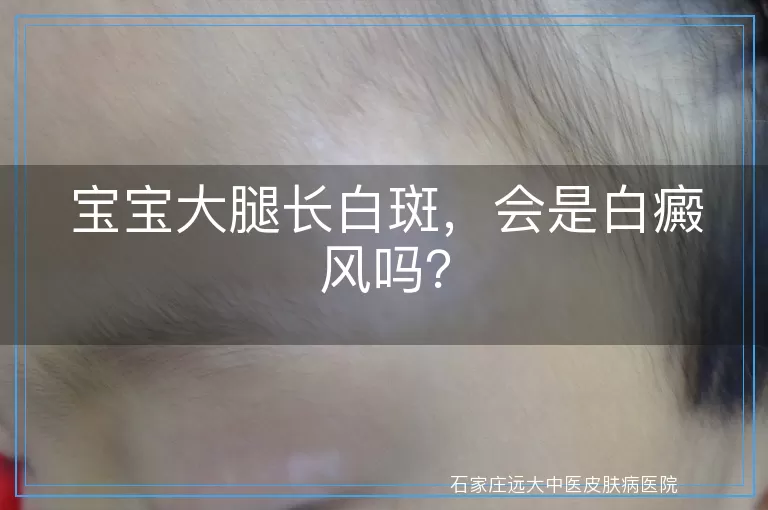 宝宝大腿长白斑，会是白癜风吗？
