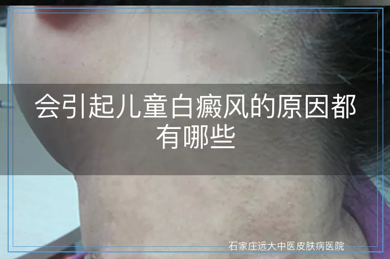 会引起儿童白癜风的原因都有哪些