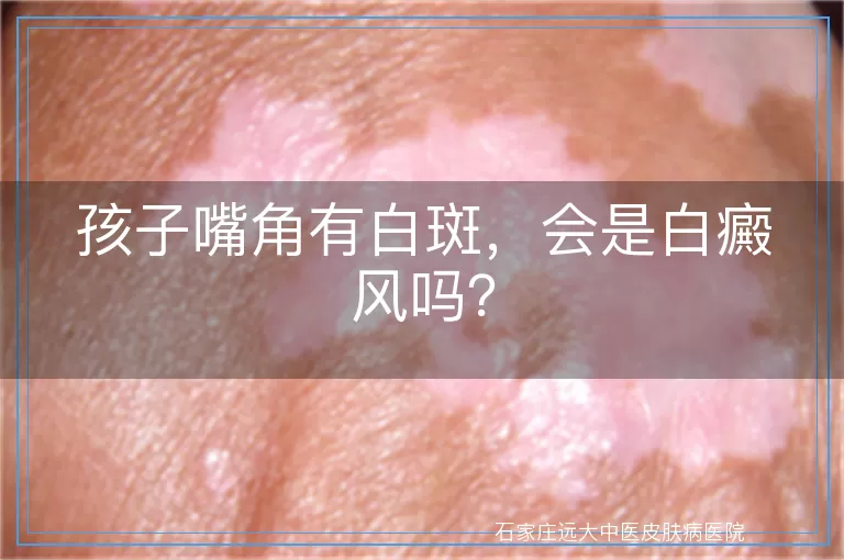 孩子嘴角有白斑，会是白癜风吗？