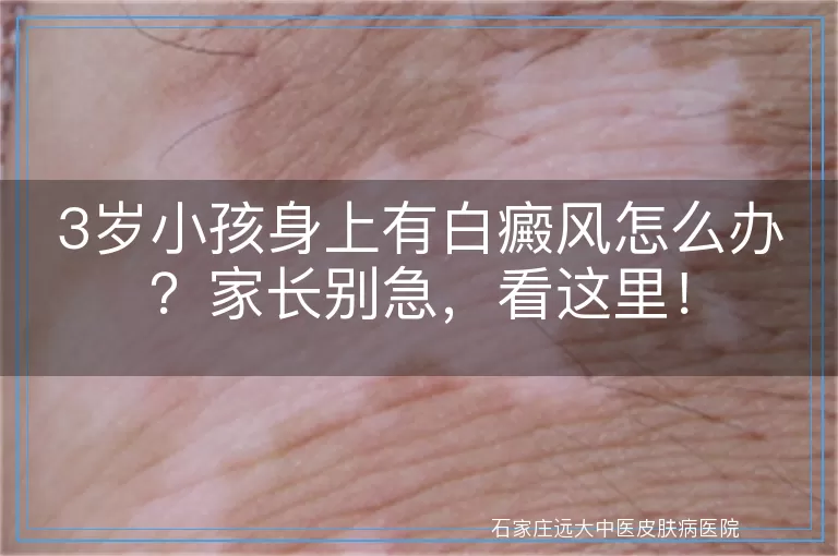 3岁小孩身上有白癜风怎么办？家长别急，看这里！